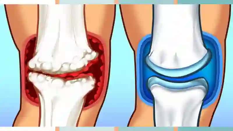 Osteoartrit 3