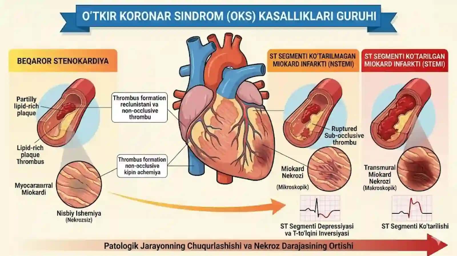 O'TKIR KORONAR SINDROM PREZENTATSIYA 3