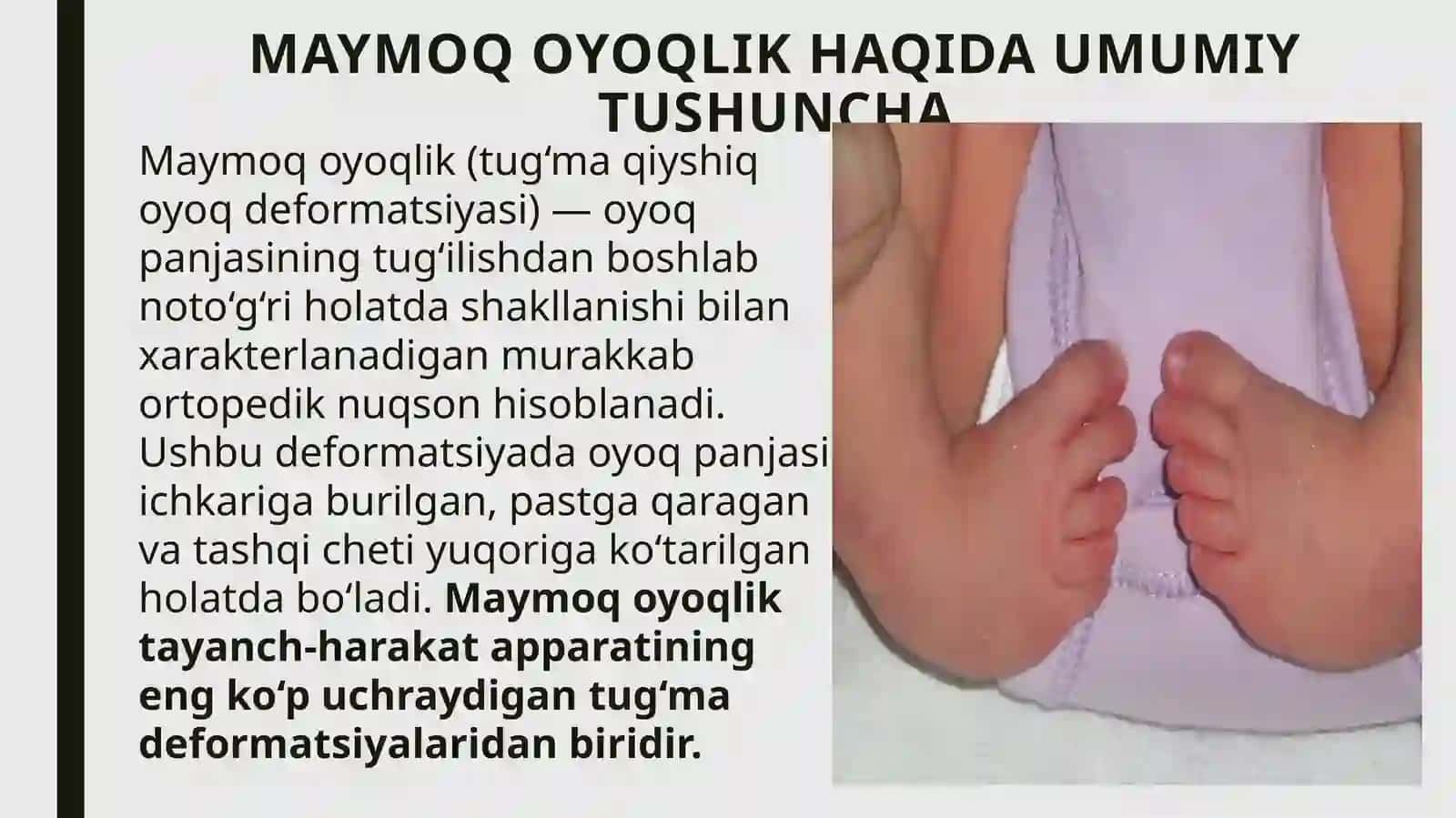 Maymoqoyoqlik (tug‘ma qiyshiq oyoq— clubfoot) 3