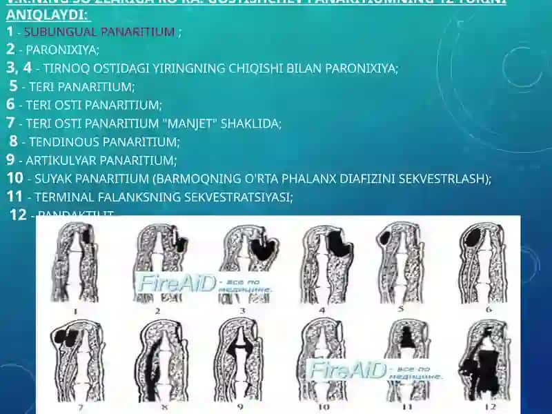 Panaritium 3