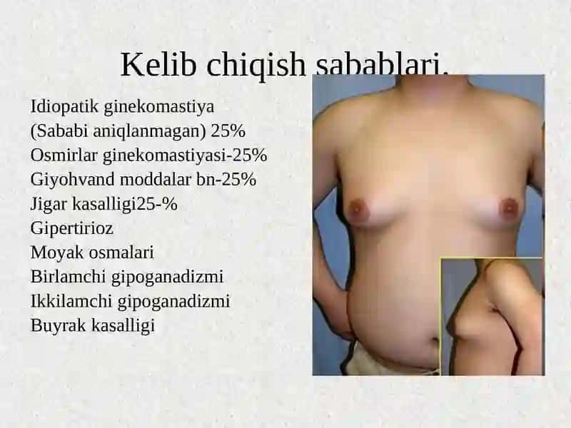 Гинекомастия 3