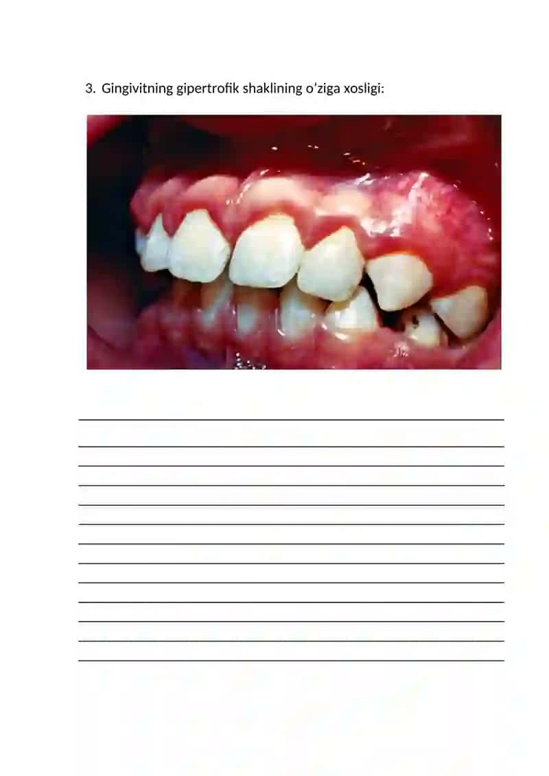 Bolalar o'tkir va surunkali, atrofik, kataral va gipertrofik gingivit. Bolalarda gingivitlarni davolash va profilaktika qilish 3