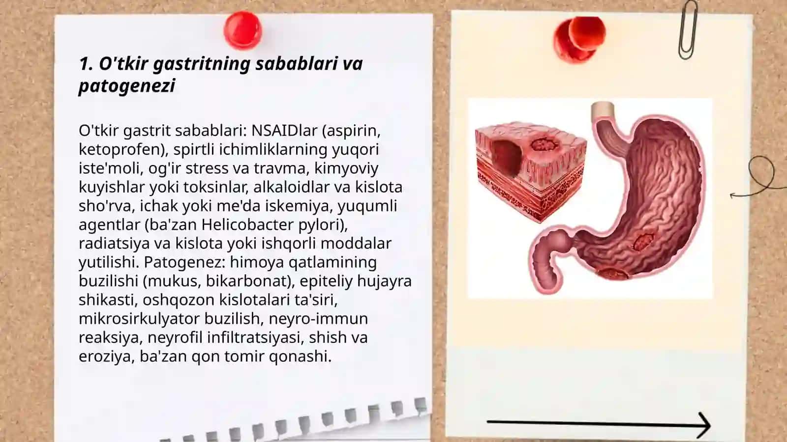 Me'da va O'n Ikki Barmoqli Ichakning Yara Kasalliklari 3