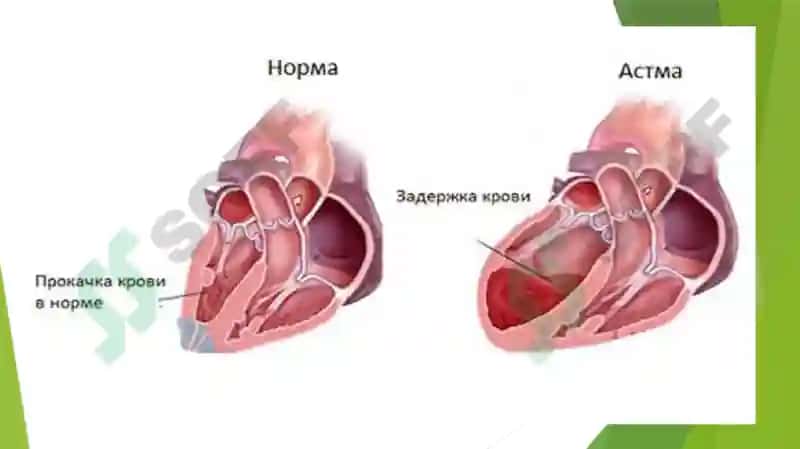 Юрак астмаси va Бронхиал астма 3