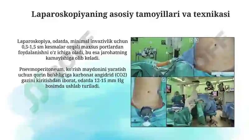 Laparoskopiyaning jarrohlikda qo’llanilishi 3