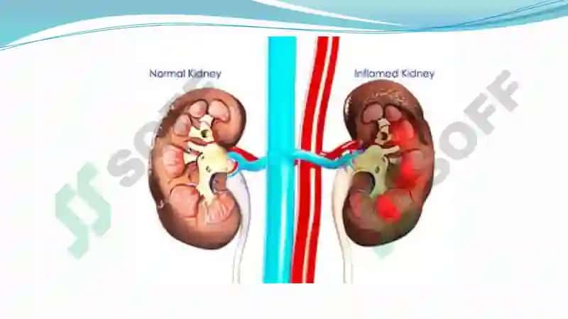 Nephritis 3