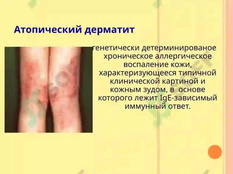 Atopik dermatit 3