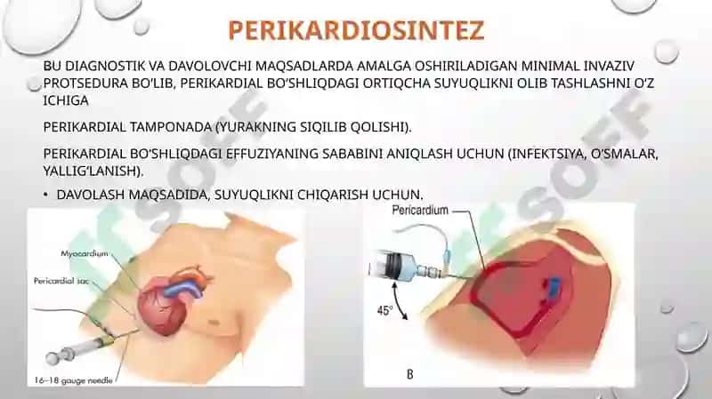 Perikarditlarda operatsiyalar 3
