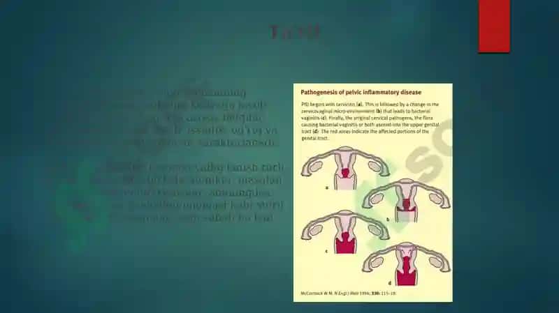 Ayollar jinsiy tizim a'zolari yallig'lanish jarayonini patofiziologiyasi 3