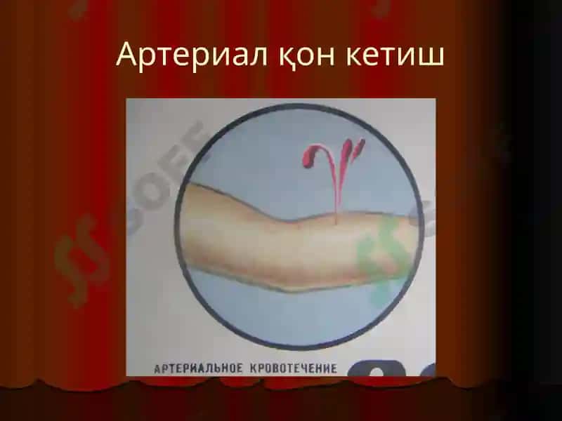 Қон кетиш 3