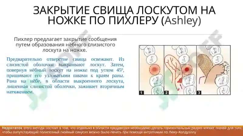 СПОСОБЫ ХИРУРГИЧЕСКОГО ЗАКРЫТИЯ СООБЩЕНИЯ МЕЖДУ ГАЙМОРОВОЙ ПАЗУХОЙ И АЛЬВЕОЛОЙ 3