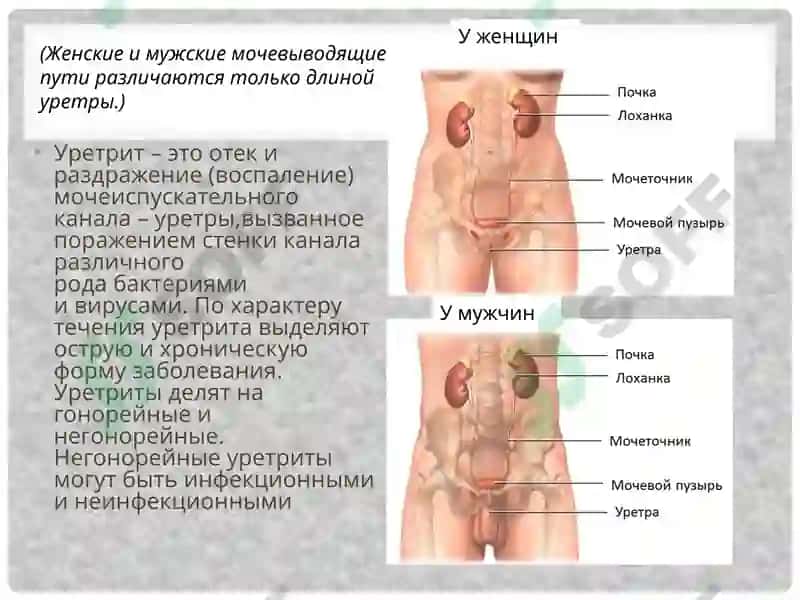 Уретрит 3