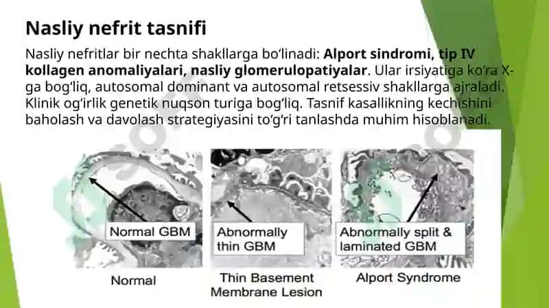 Nasliy nefrit: tasnif, patogenez, klinikasi, diagnostikasi, differensial diagnostikasi va davolash 3