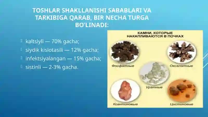 Siydik tosh kasalligi 3