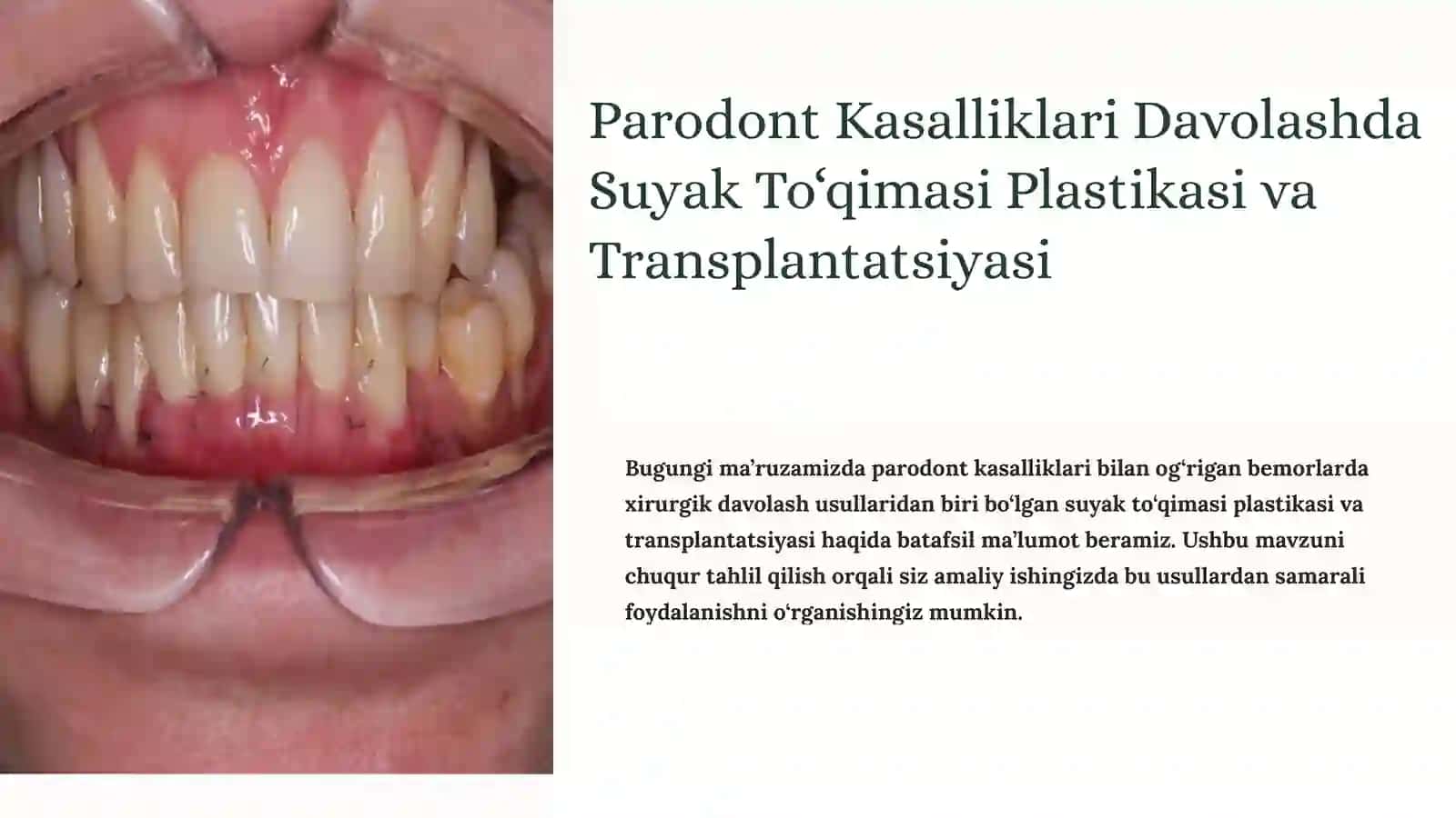 Parodont Kasalliklari Davolashda Suyak To‘qimasi Plastikasi va Transplantatsiyasi 3