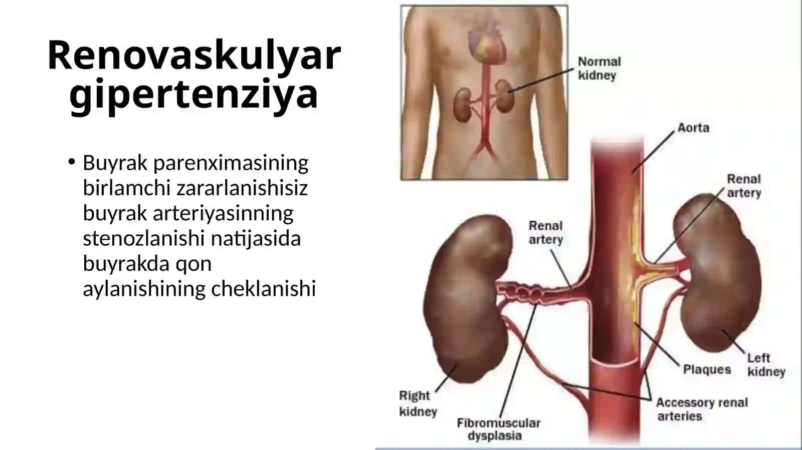 Renovaskulyar gipertenziya 3