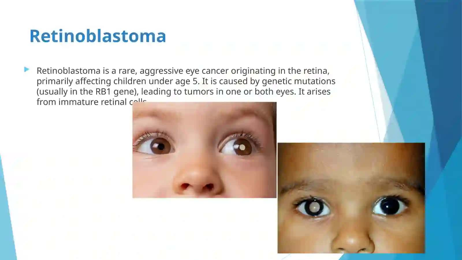 RETINOBLASTOMA 3