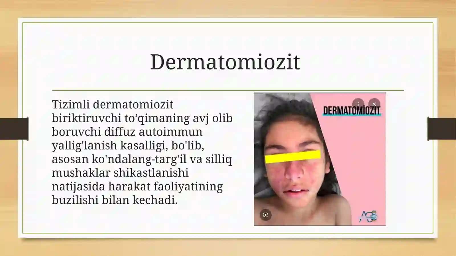 dermatomiozit 3