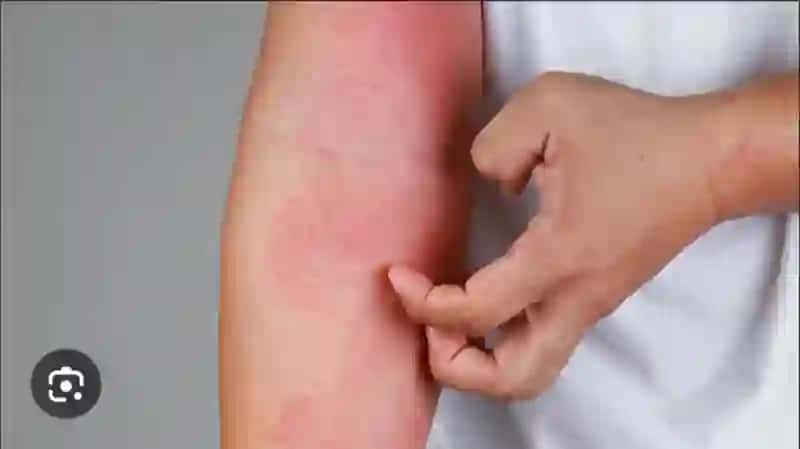 Dermatitlar. Toksikodermiya. Ekzema. 3