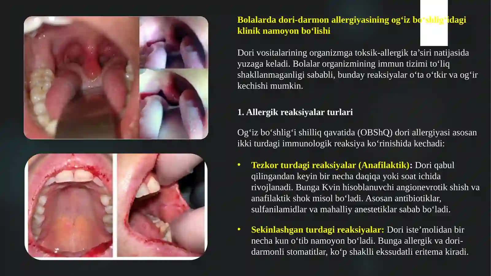 Dori-darmon allergiyasida bolalarda og‘iz bo‘shlig‘i shilliq qavatidagi o‘zgarishlar, klinik belgilari, tashxisi, davosi 3