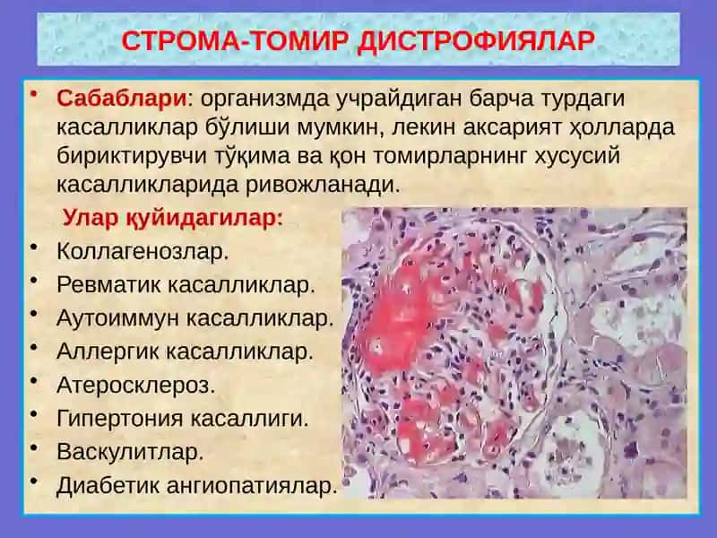Строма-томир дистрофиялар 3