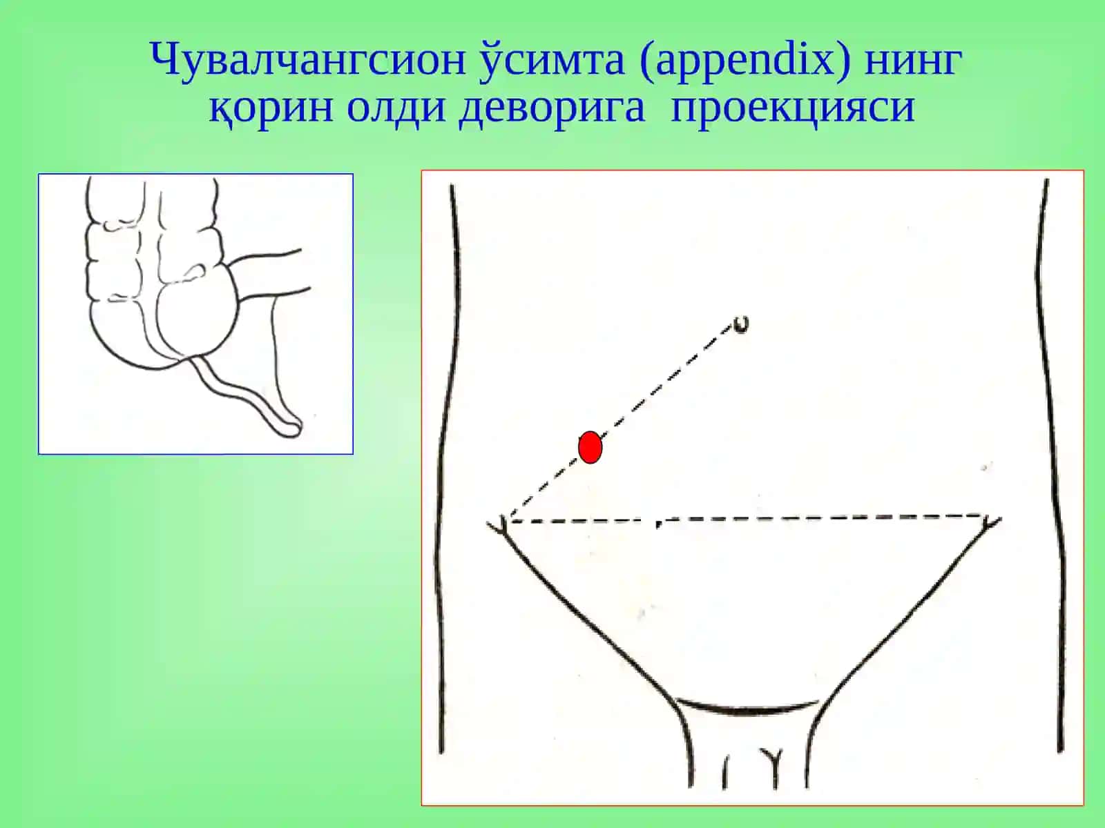 Ўткир аппендицит 3