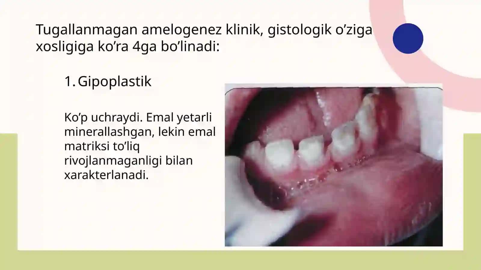 Tishqattiq to'qimasining nasliy kasalliklari 3
