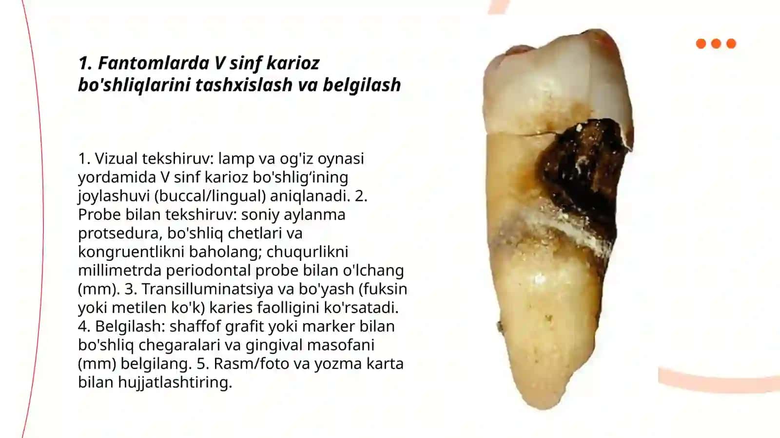Fantomlarda V sinf karioz bo'shliqlarini charxlash va plombalash 3