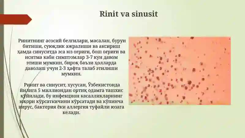 Rinit va sinusit 3
