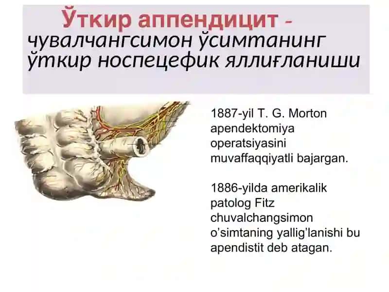 O`tkir appenditsit 3
