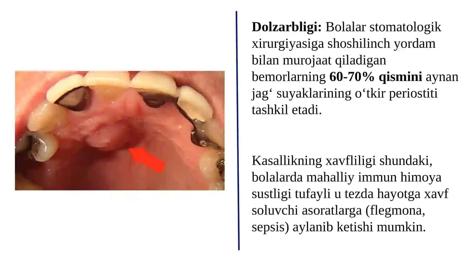Bolalar Jag' Suyagining O'tkir va Surunkali Periostiti 3