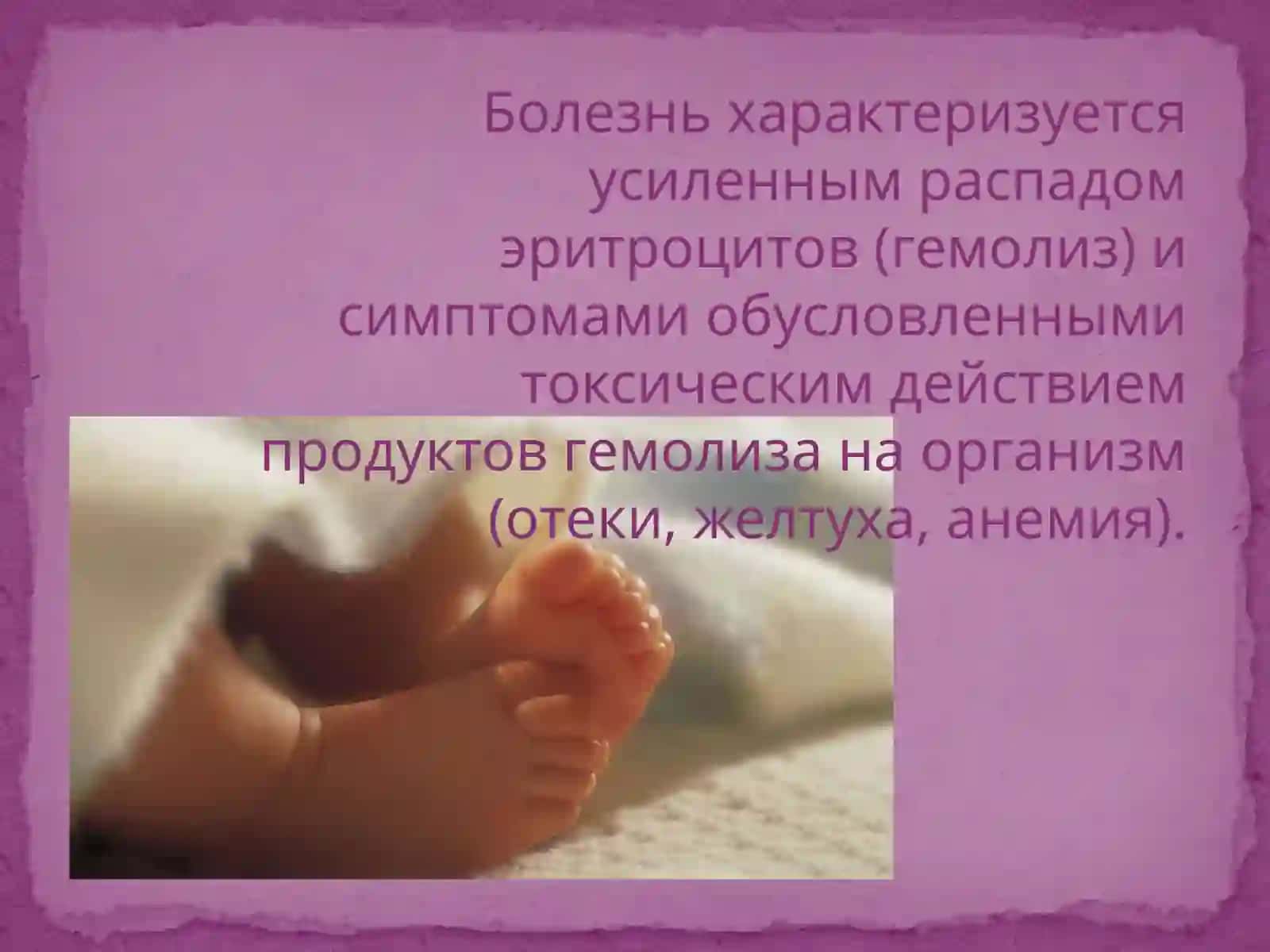 Гемолитическая болезнь новорожденных 3