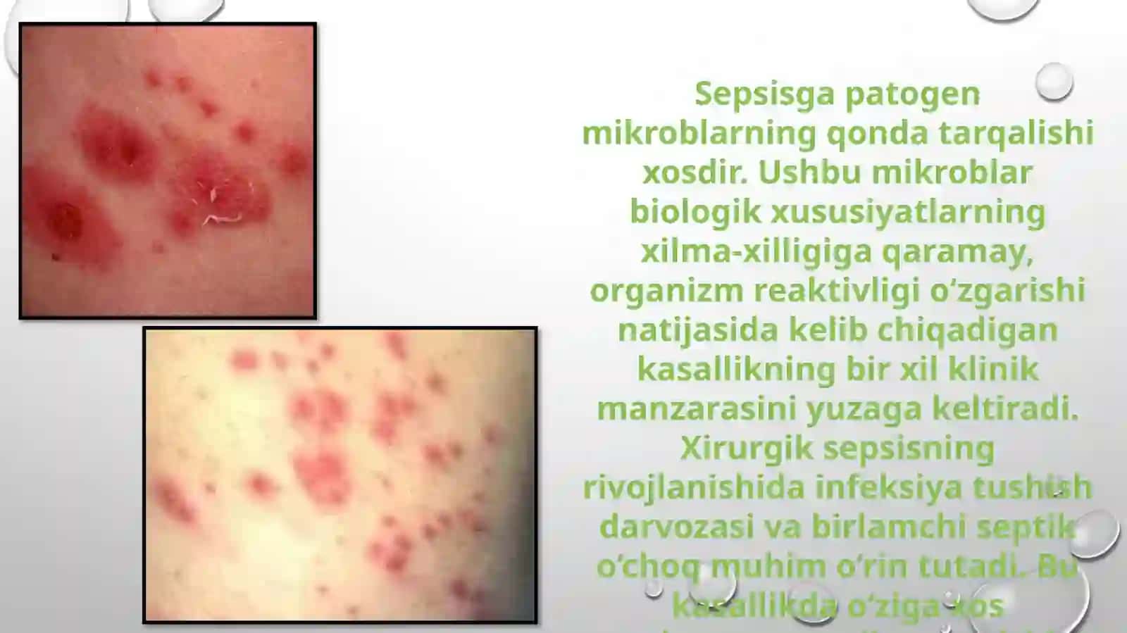 Sepsis, uning diagnostikasi va davolash 3
