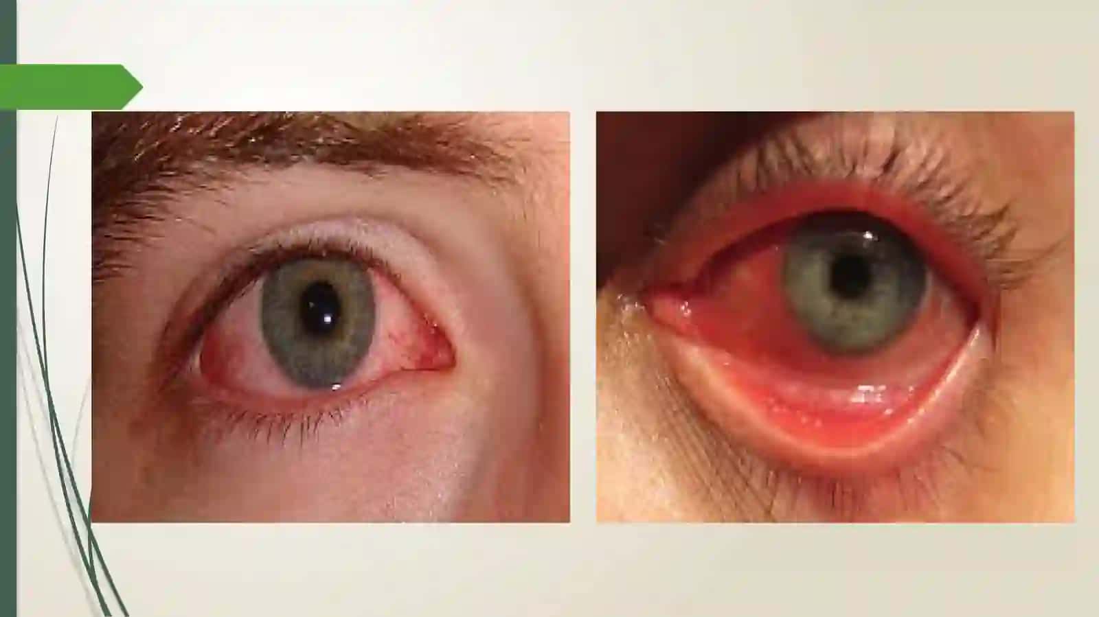 Viruslikon’yunktivitlar—ko‘zqizarishining,ko‘risho‘tkirligipasaymaganholatdagisababiklinikasi,diagnostikasivadavolash 4