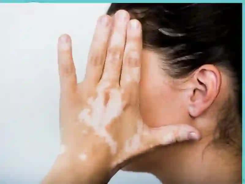 VITILIGO HAQIDA 4