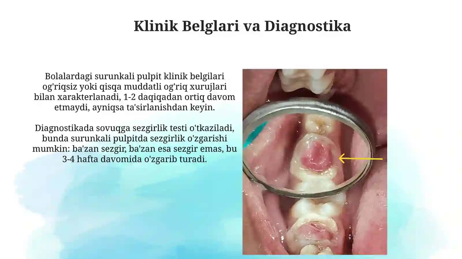 Surunkali pulpitning tanqisai va davolash usullari 4