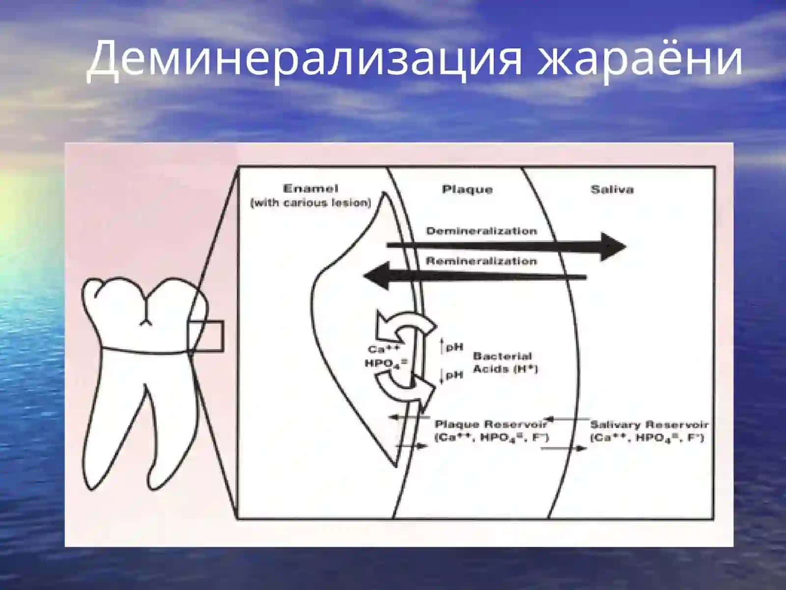 Кариес ҳақида тушунча. Кариесковакларни таснифи 4
