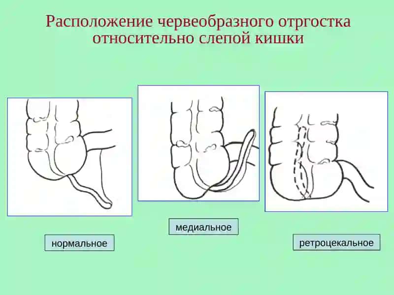 Острый аппендицит 4
