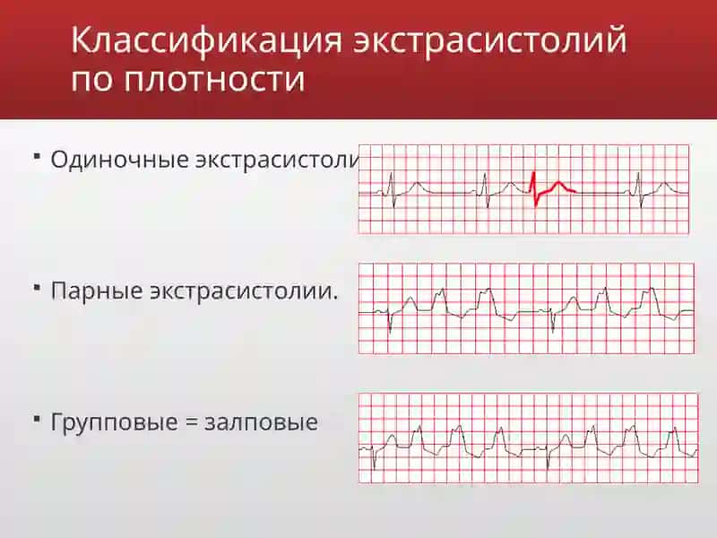Экстрасистолии 4