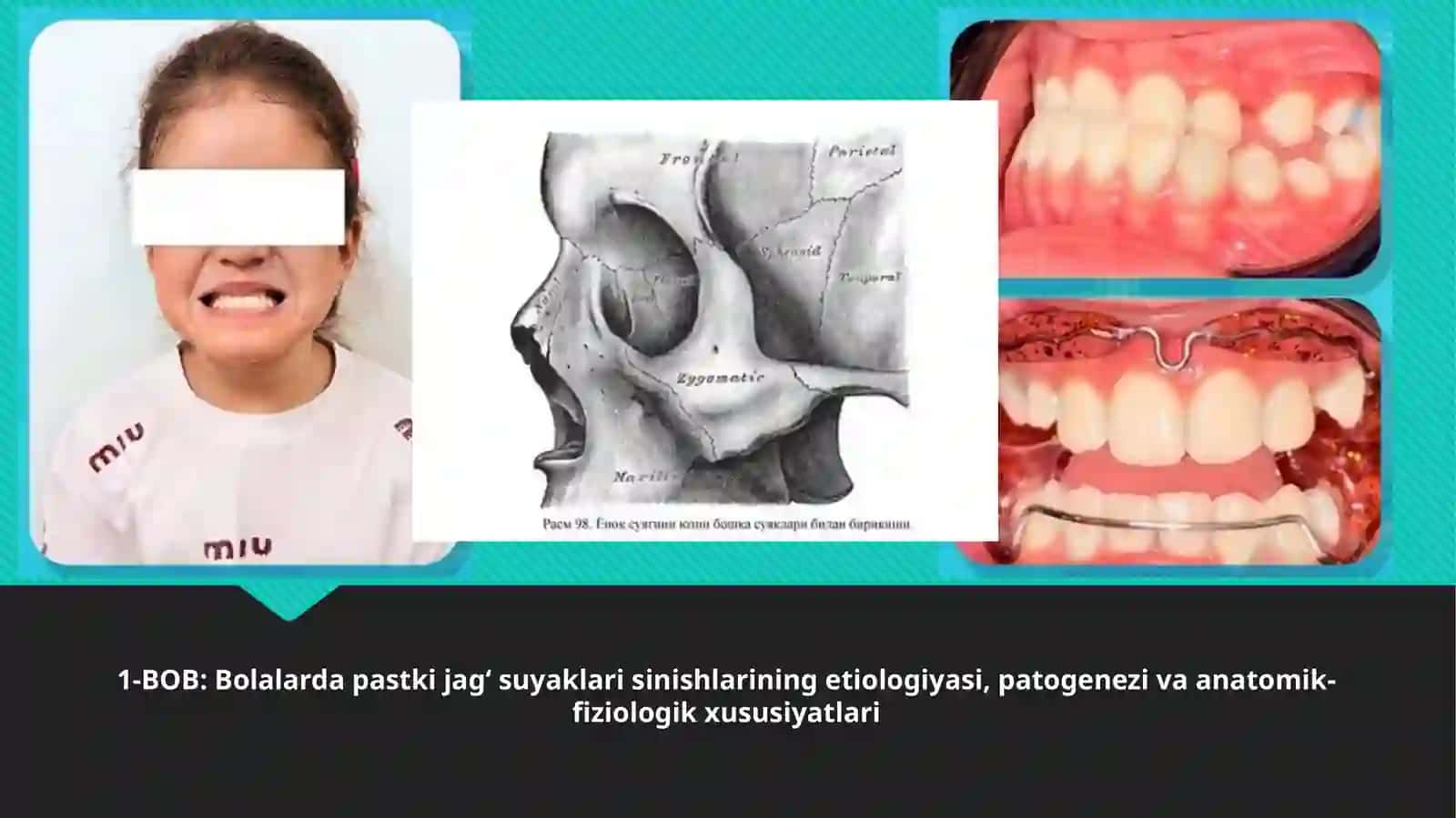 Bolalarda pastki jag‘suyaklari sinishlari 4