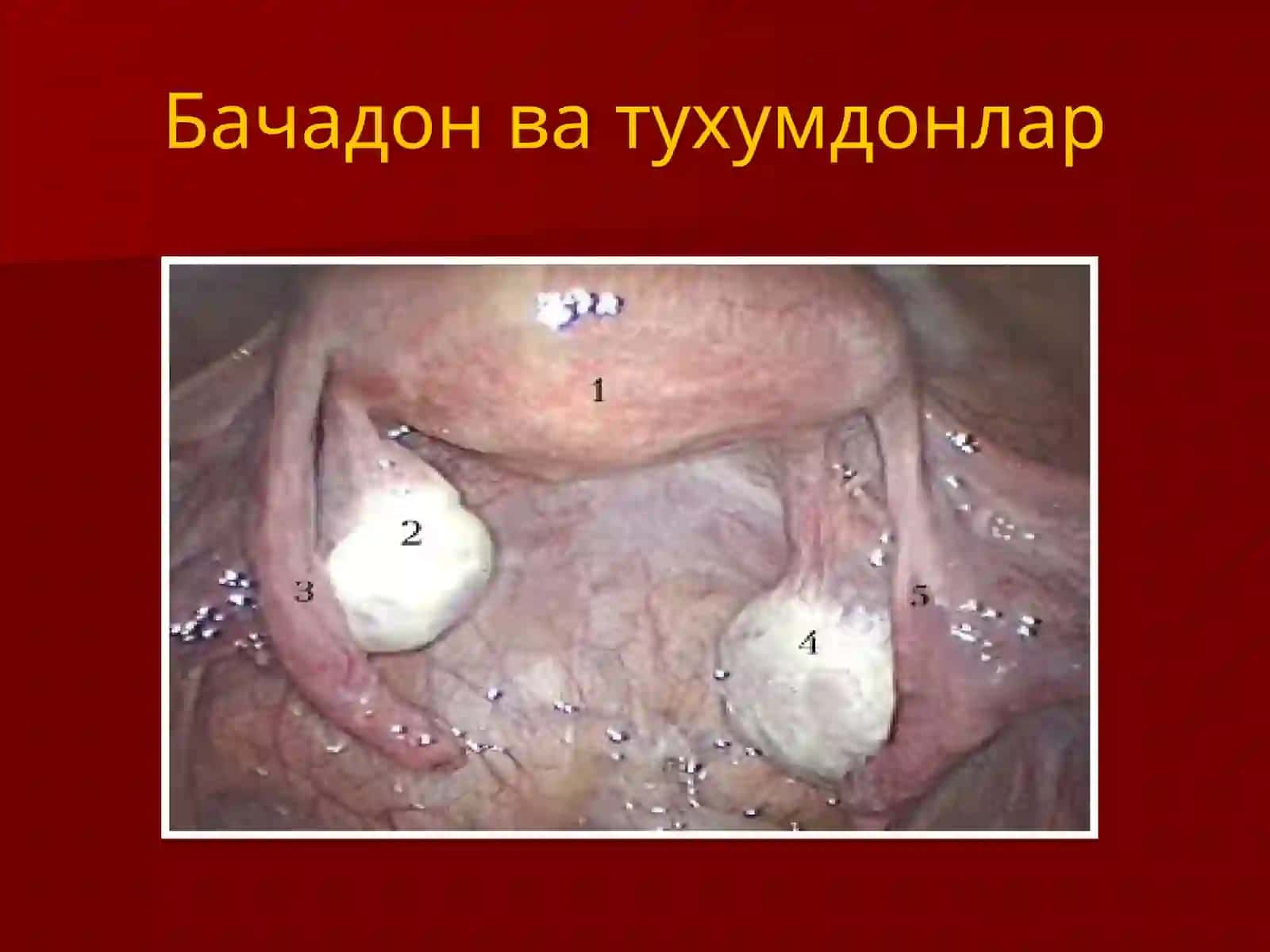 ТУХУМДОН КИСТА ВА КИСТОМАЛАРИ 4