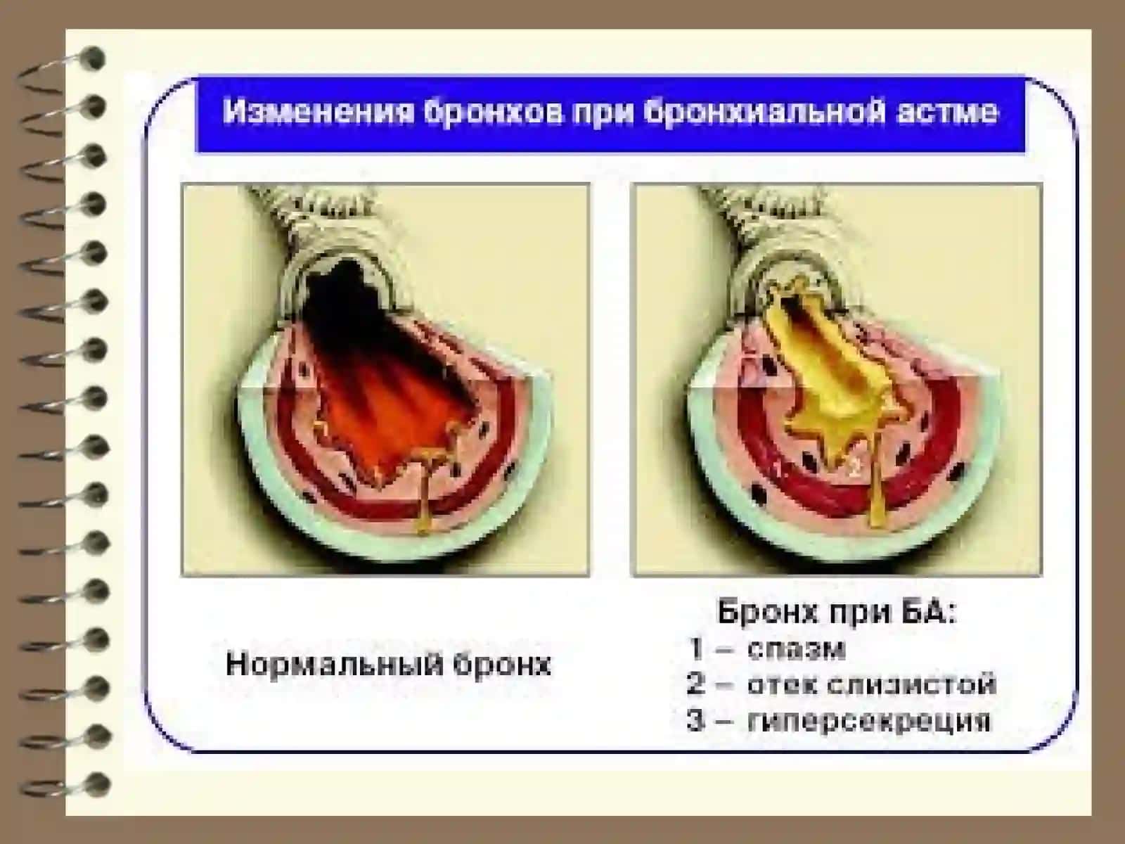 Бронхиал астма.Ўпканинг сурункали обструктив касалликлари.Ўпкаҳавочанлигининг ошиши синдроми.Ўпка эмфиземаси 4