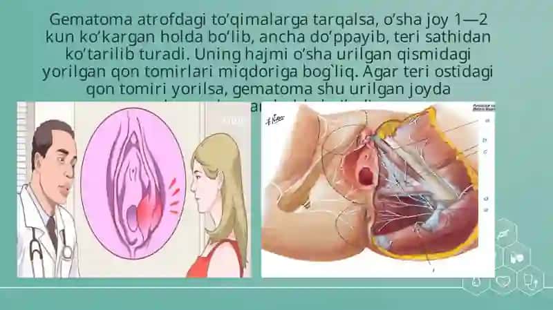 QIZ BOLALARDA JINSIY A’ZOLARNING JAROHATLARI. JAROHATLARDA BIRINCHI SHIFOKOR YORDAMINI KO’RSATISH 4