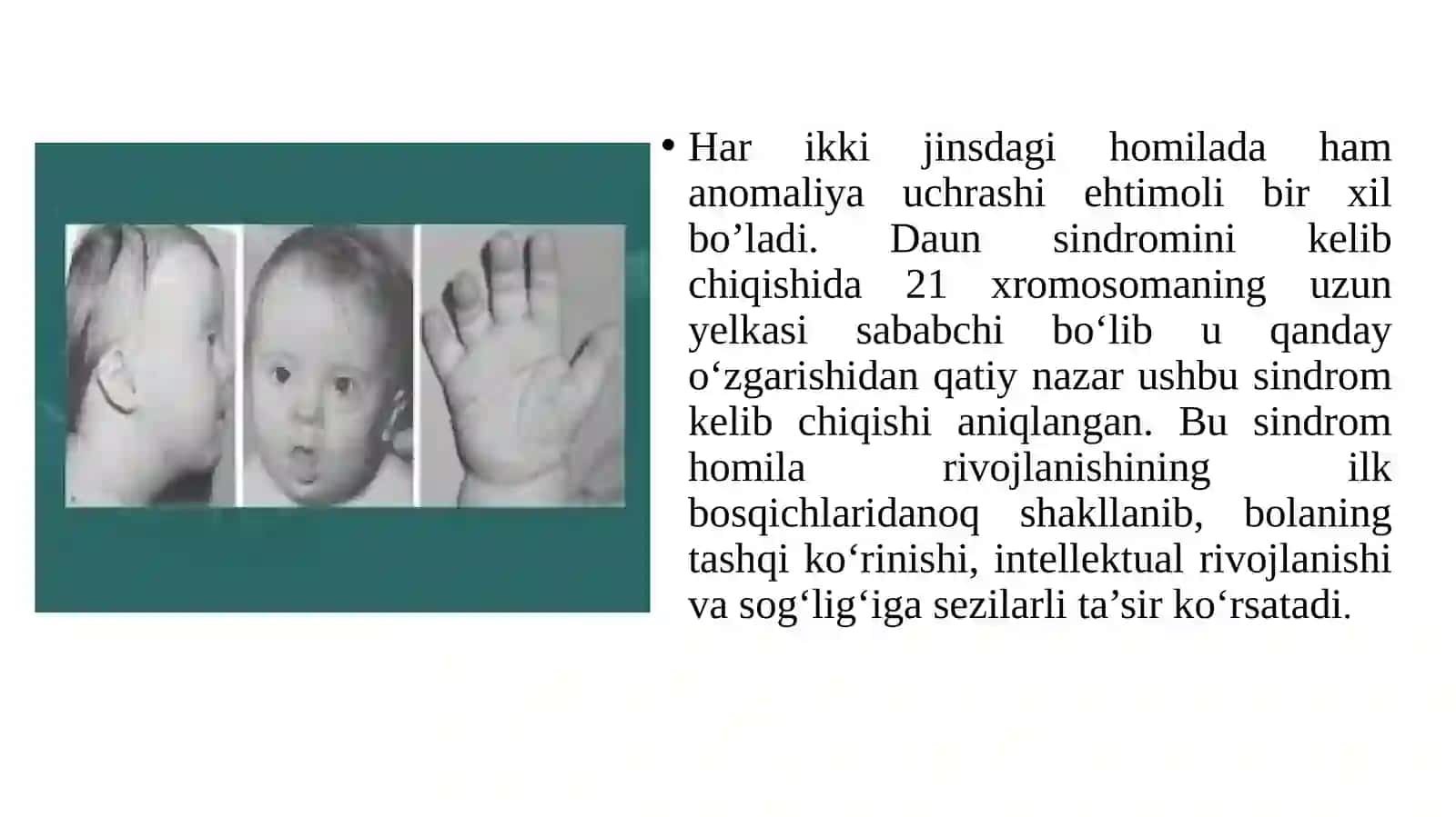 Daunsindromi Xastaligi 4