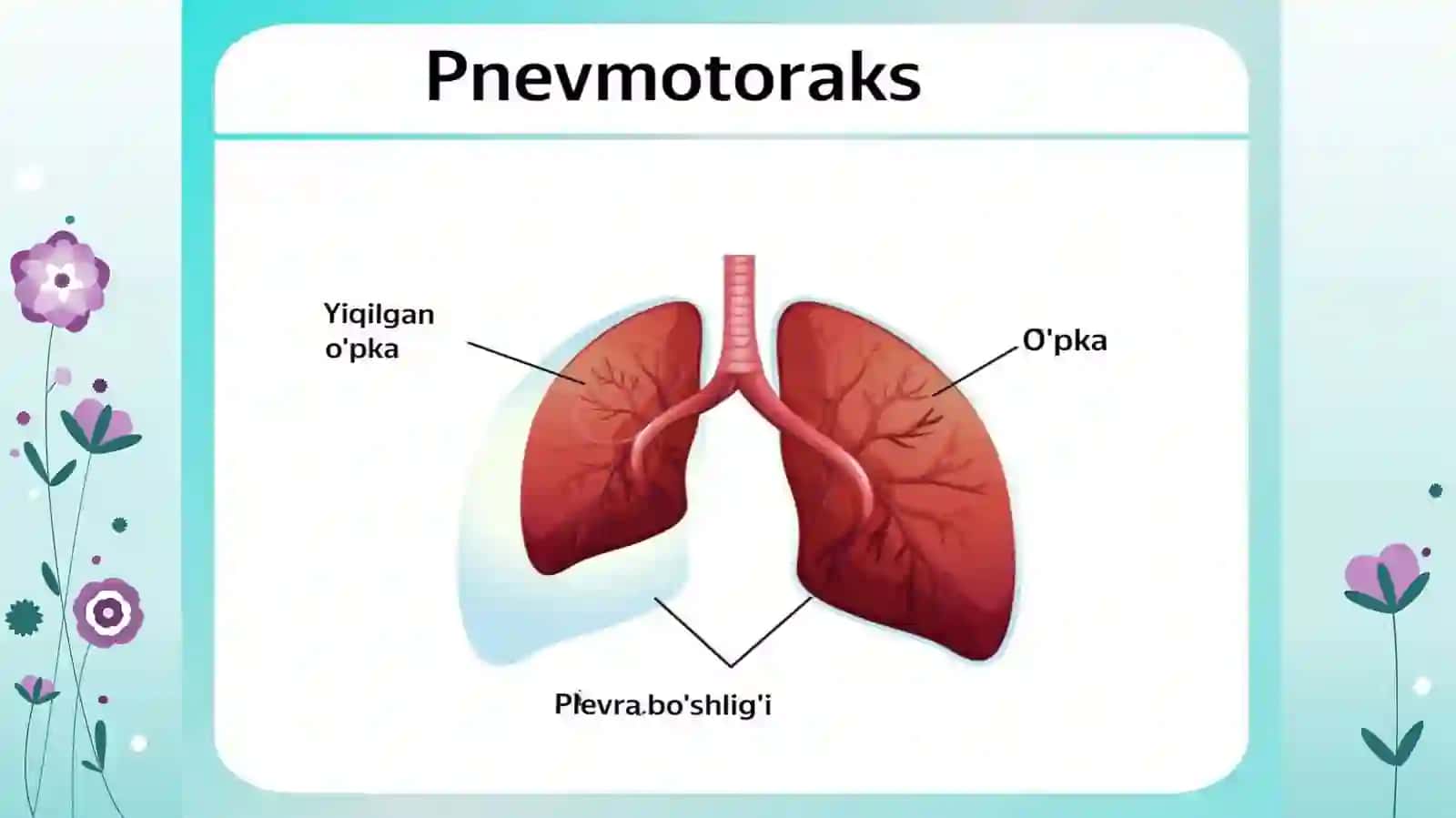 Tuberkulyozning shoshilinch tibbiy yordam talabqiluvchi asoratlari:Spontan Pnevmotoraks 4
