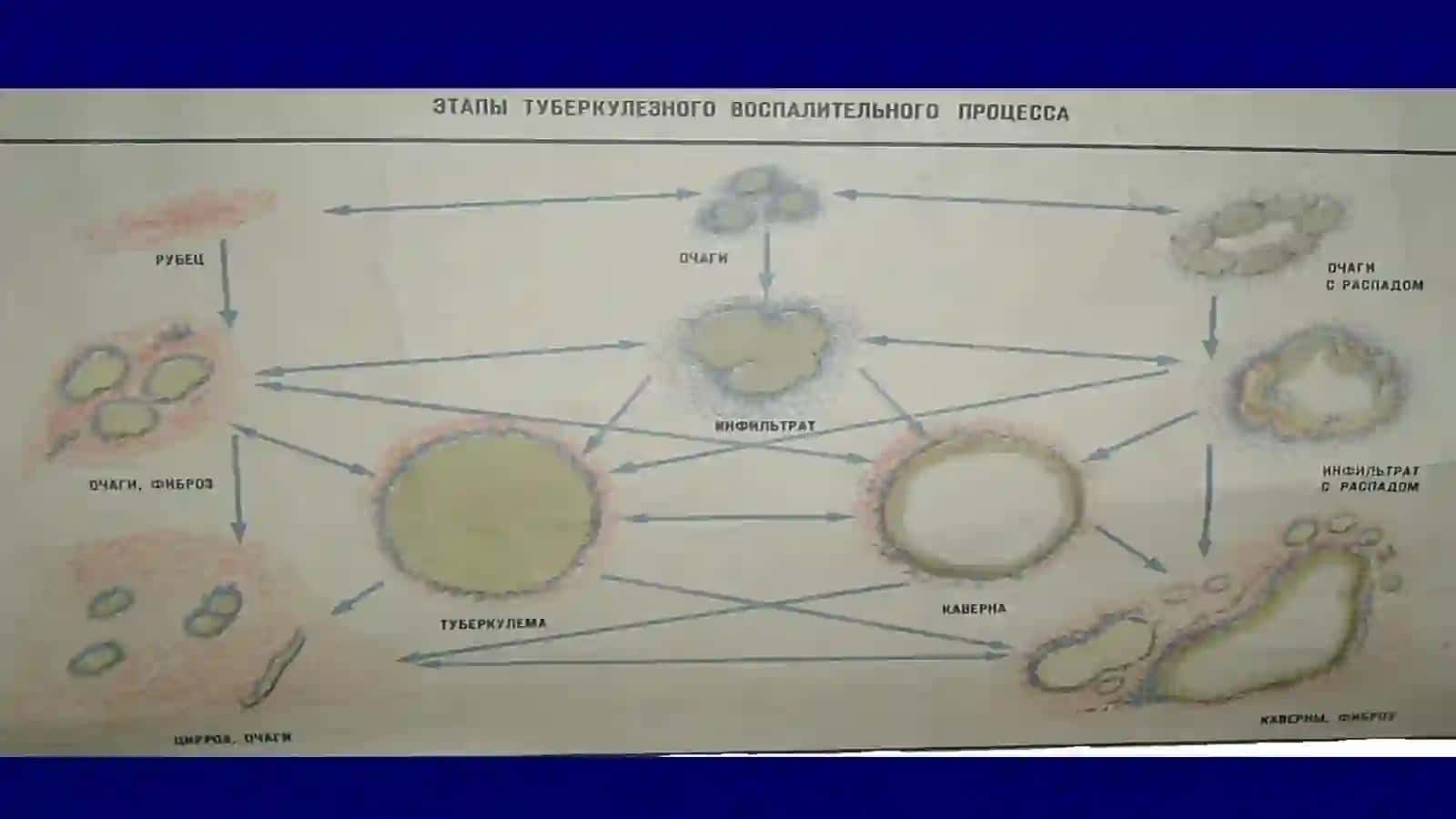 Ўпканинг кавернали, фиброз-кавернали ва цирротик туберкулези 4