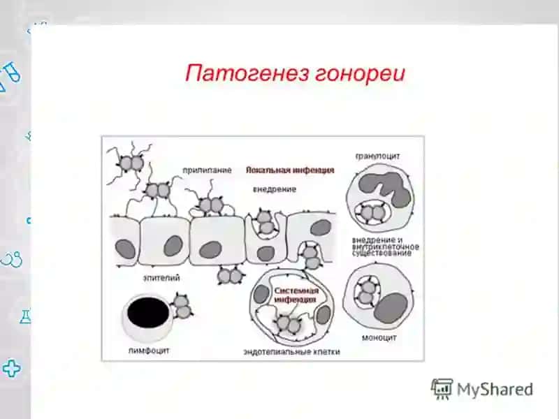 Гонорея 4