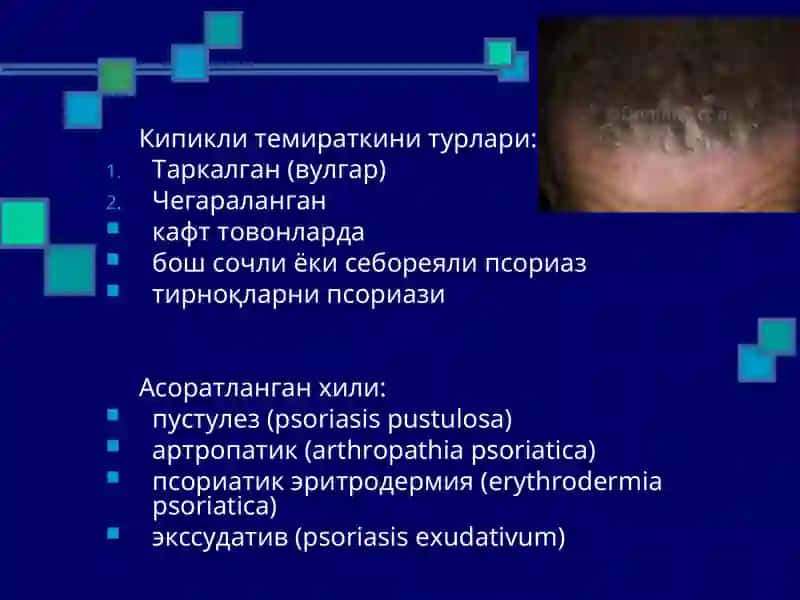 Псориаз 4