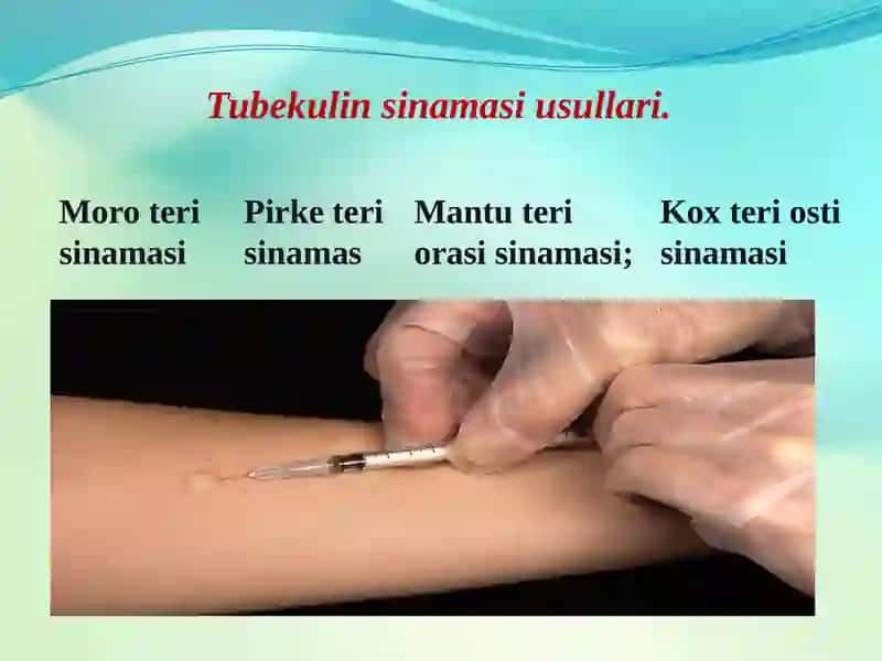 Tuberkulinodiagnostika 4