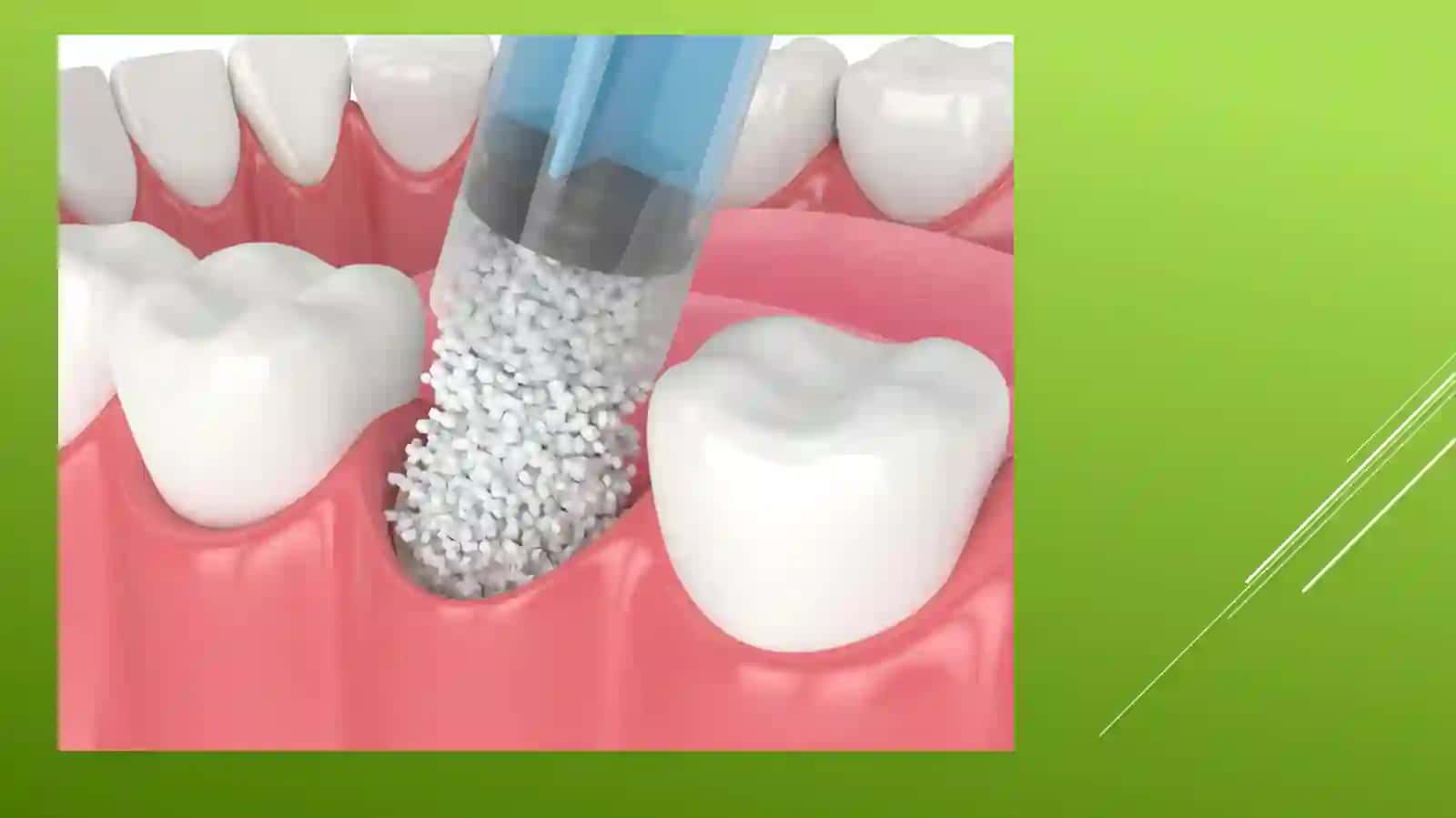 Parodontal xirurgiyada qattiq to'qimalar transplantatsiyasi 4